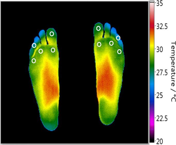 Thermal map of both feet from a published temperature assessment study